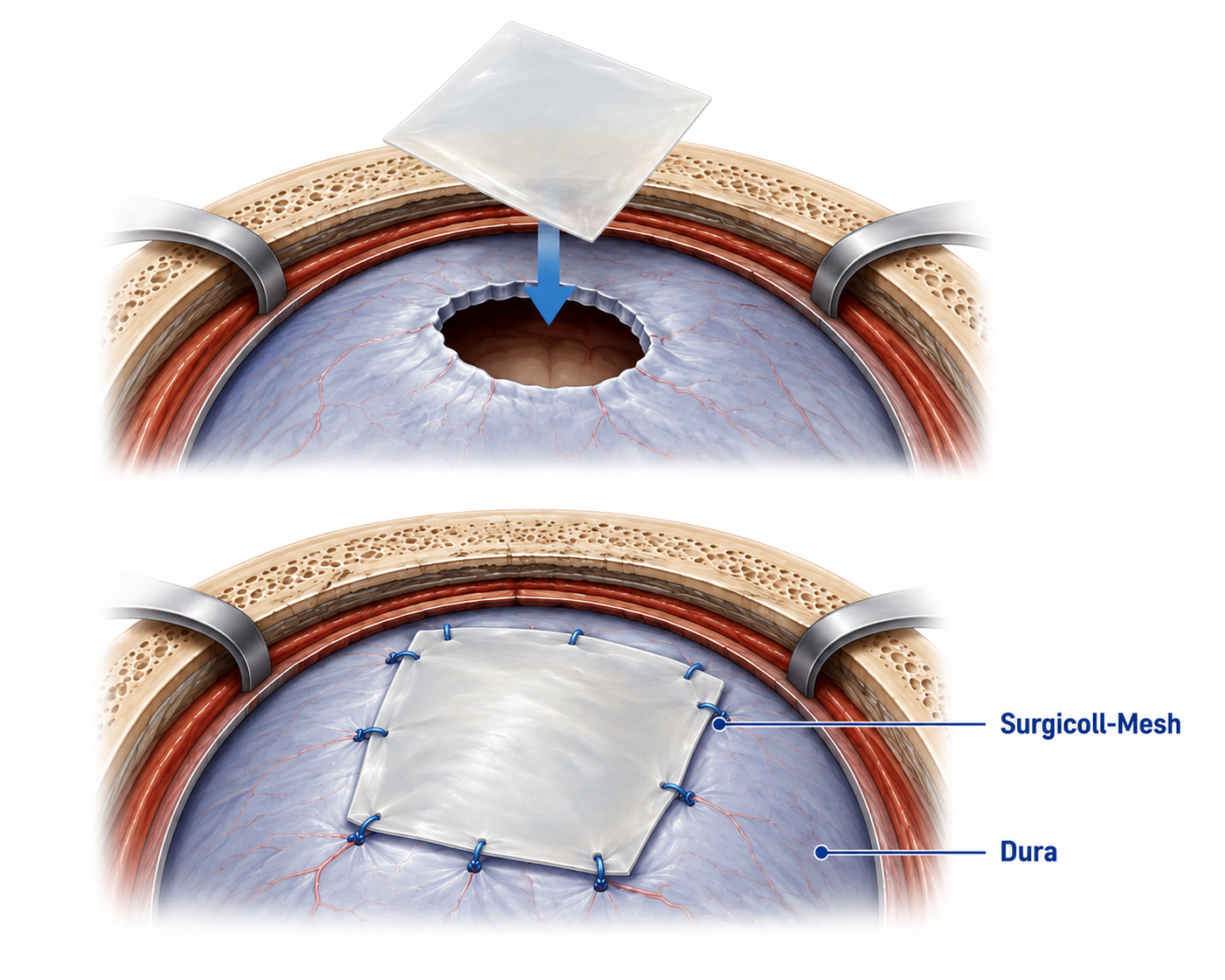 Illustration showing a Surgicoll-Mesh patch being placed over a dural defect and sutured in place over the dura.